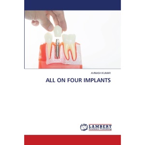 ALL ON FOUR IMPLANTS